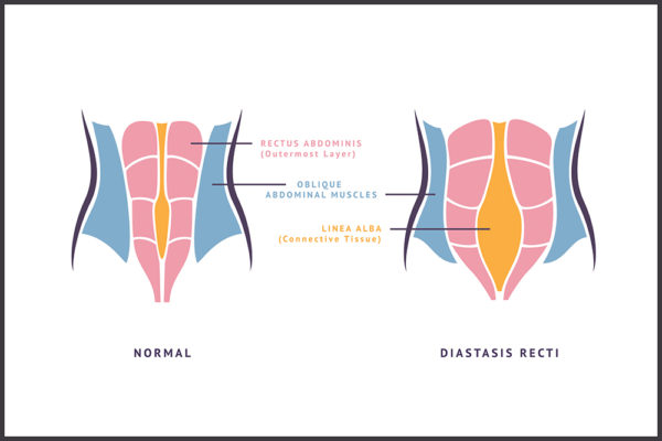 What is Diastasis Recti and How to Avoid it During Pregnancy ...